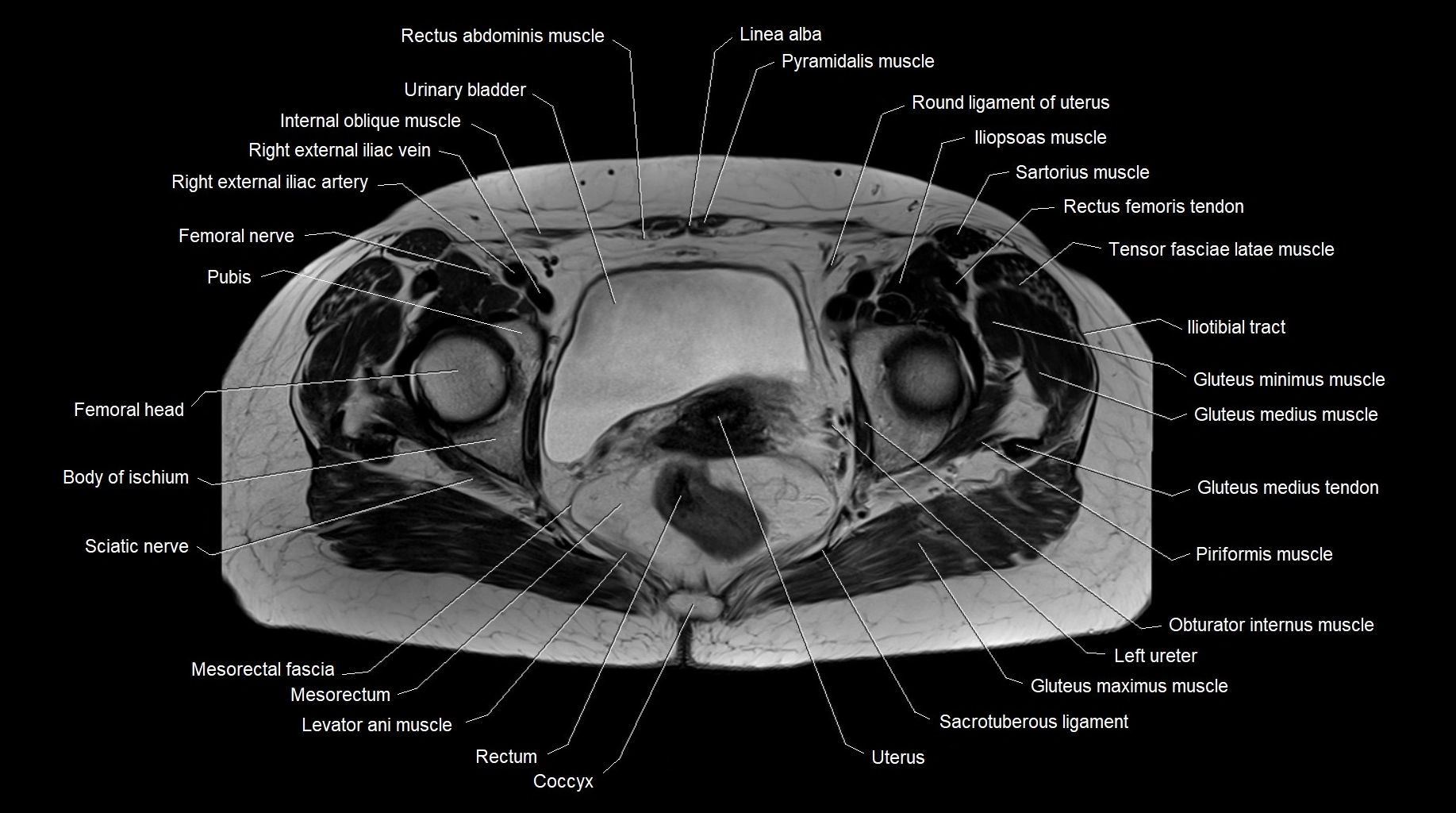 MRI 3T pelvis axial cross section anatomy image 21.webp